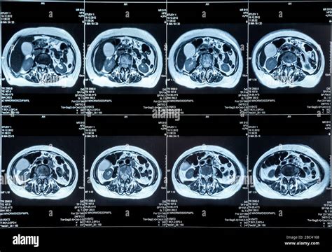 What Does an Abdominal MRI Show: A Journey Through the Mysteries of the Human Body